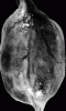 Myxopapillary Ependymoma, gross photograph of surgical resection