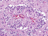 Angiocentric Glioma, high power H&E stain