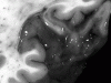 Dysembryoplastic Neuroepithelial Tumor, Coronal section at the level of the parietal occipital junction.