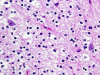 Dysembryoplastic Neuroepithelial Tumor, H&E stain