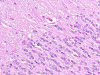 Lhermitte-Duclos disease, H&E stained section