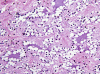 Rosetted Glioneuronal Tumor IVth Ventricle H&E