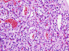 Hemangioblastoma,  H&E stain x 200