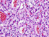 Hemangioblastoma, H&E stain x 400