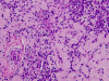 Amyloidotic plasmacytoma, H&E stain x200