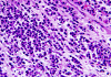 Plasmacytoma, H&E stained slide x 400