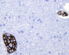 Intravascular lymphomatosis, CD20 immunohistochemical staining