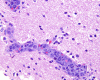 Intravascular lymphomatosis, stereotactic biopsy, H&E stain x 400