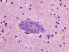 Intravascular lymphomatosis, H&E stain x 400