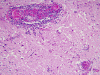 Leptomeningeal and perivascular spread of leukemic cells in a patient with AML, H&E stain x 100