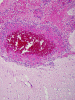 Meningeal Leukemia x200