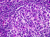 Extranodal marginal zone B-cell lymphoma (MALToma) of dura mater, H&E stain x 400