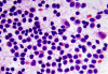 Extranodal marginal zone B-cell lymphoma (MALToma) , intraoperative smear,H&E stain x 400