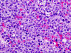 Primary central nervous system lymphoma, H&E stain x 200