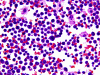 Primary central nervous system lymphoma, intra-operative crush preparation x 400