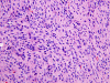 Anaplastic meningioma, H&E stained section