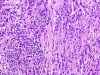 Atypical meningioma, H&E stained section.