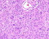 Meningioma, WHO grade I,  H&E stain x 100