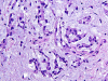 Chordoid Meningioma (WHO Grade II), H&E stained section, high power view.