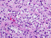 Clear Cell Menigioma, H&E