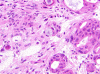 Meningioma containing adenocarcinoma, intraoperative frozen section.