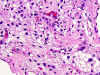 Microcystic meningioma, high power H&E stain.