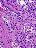 Papillary meningioma, high power H&E stained section.