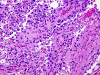 Papillary meningioma, low power H&E stained section