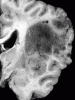 Metastatic Malignant Neuroectodermal Tumor, coronal section of brain at the level of the thalamic nuclei.