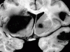 Metastatic melanoma, coronal section of brain at level of basal ganglia.