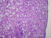 Subependymoma of lateral ventricle, H&E stain x 100