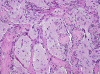 Menigioangiomatosis, H&E stain x 40