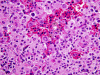 Primary Meningeal Melanoma, H&E stain x 400