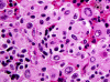 Primary Meningeal Melanoma H&E x400