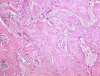 Sclerotic meningioangiomatosis, H&E stain x 100.