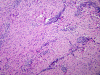 Neurofibroma