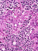 Anaplastic Oligodendroglioma, H&E stained x 400