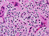 Oligodendroglioma, high power H&E