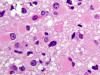 Oligodendroglioma, minigemistocytes, H&E stain x 400