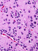 Oligodendroglioma, cortical invasion with perineuronal satellitosis