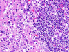 Pineal region germinoma, H&E stained slide