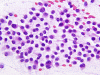 Pit Adenoma Carcinoma Smear