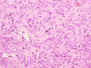 Spindle Cell Oncocytoma 1