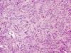 Spindle Cell Oncocytoma H&E