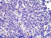 Atypical teratoid/rhabdoid tumor, BAF-47 immunohistochemical staining