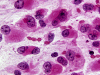 Atypical Teratoid Rhabdoid Tumor, intraoperative smear preparation x 600 (H&E stain).