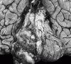 Atypical Teratoid Rhabdoid Tumor, ventral surface of brain.