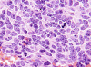 Medulloblastoma, large cell anaplastic variant, H&E stain slide x 400