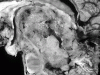 Medulloblastoma, mid sagittal section of brain