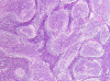 Medulloblastoma With Extensive Nodularity, H&E stain x 100